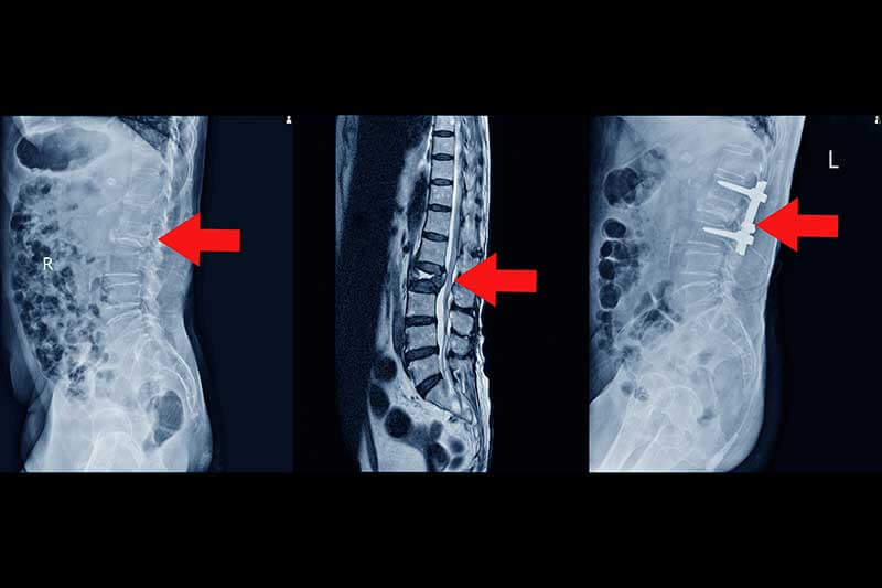 lesión de médula espinal
